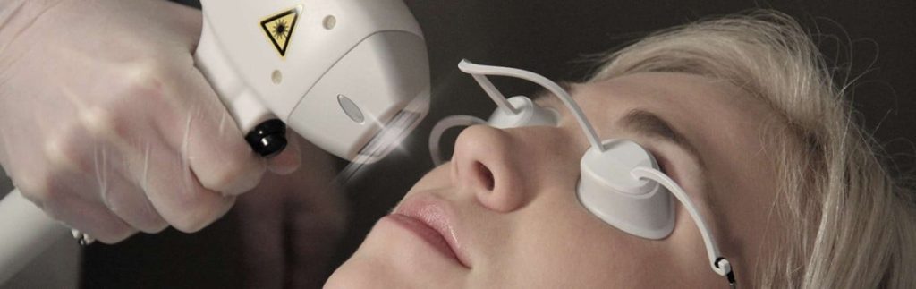 eyeball protectors on patient by Lasermet Laser Safety Solutions