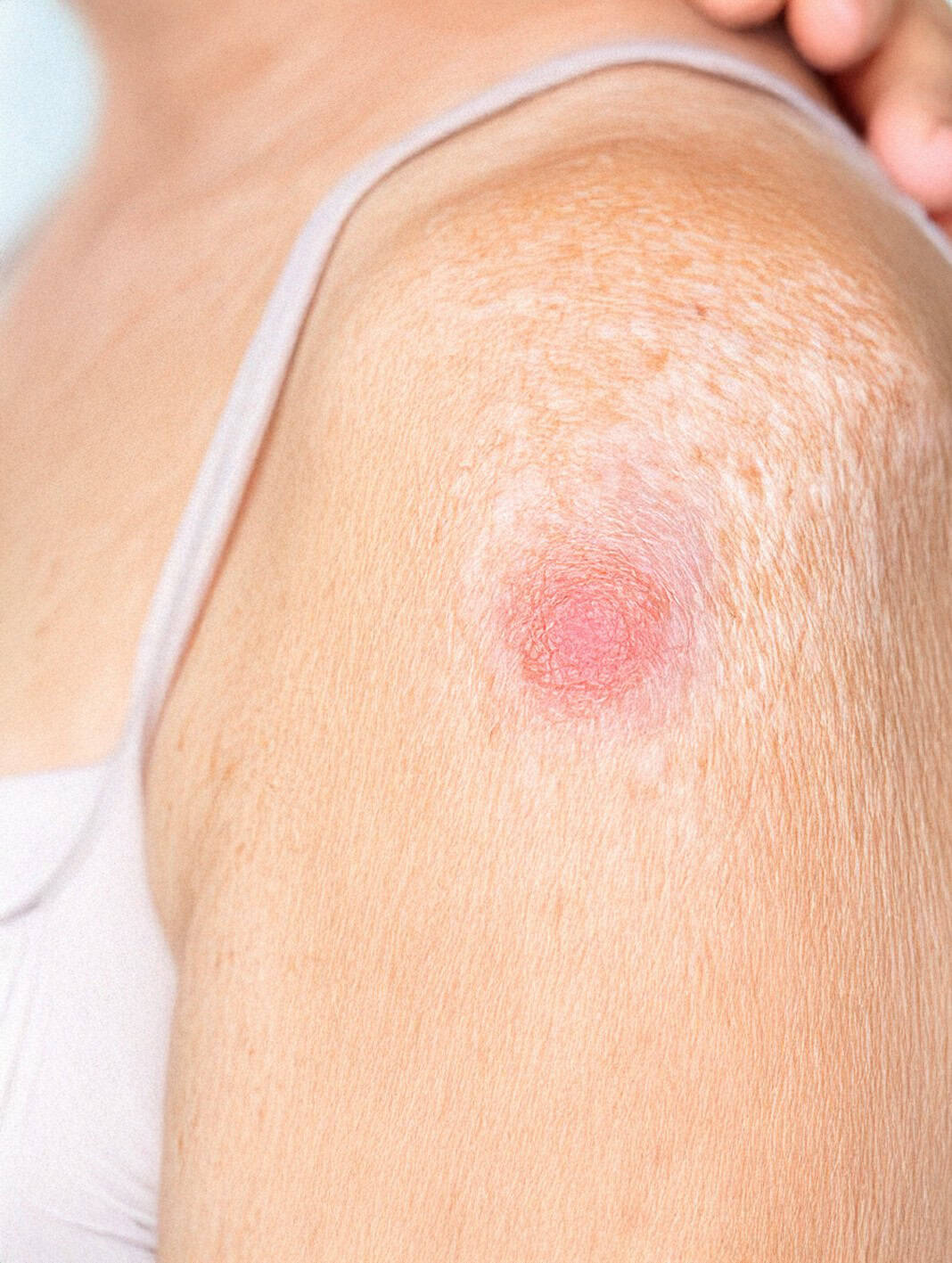 skin cancer by Lasermet Laser Safety Solutions